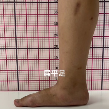 扁平足的孩子