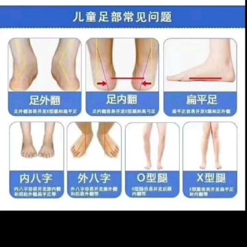 扁平足矫正
